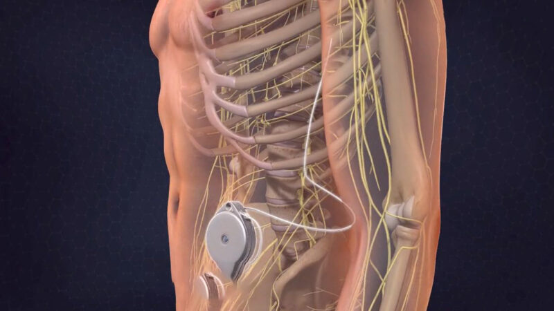 Intrathecal-pain-pumps-image
