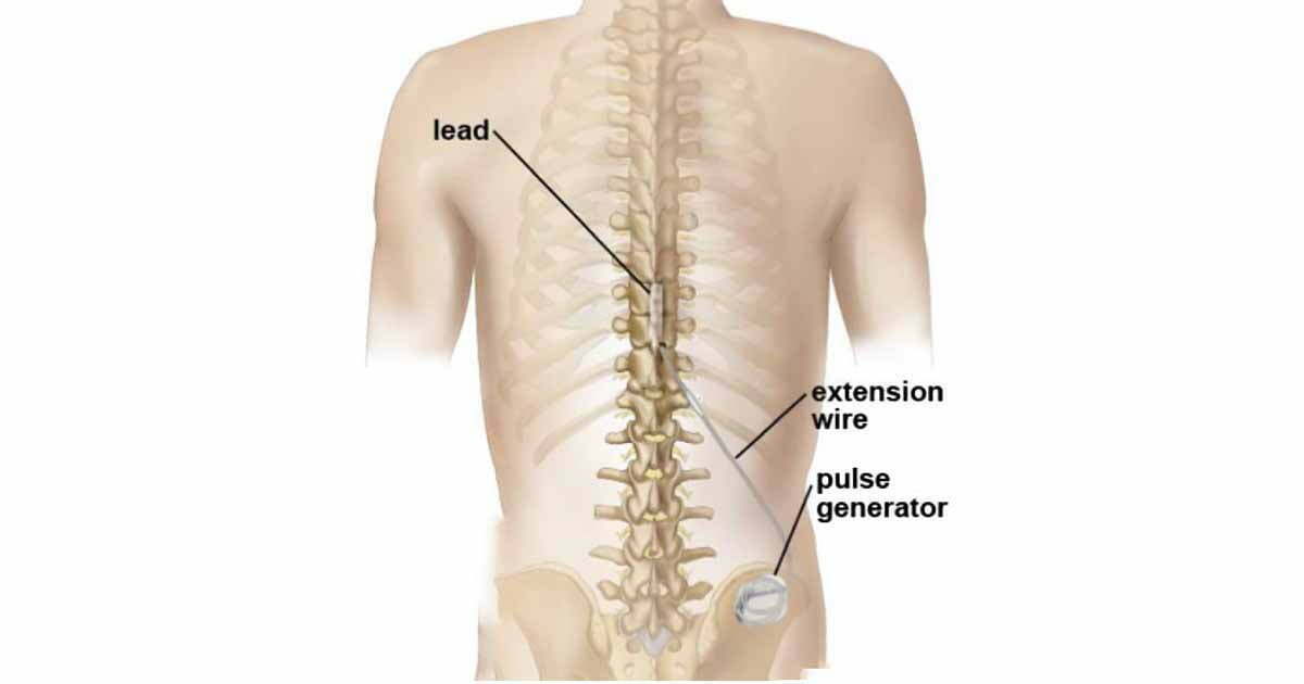 Spinal Cord Stimulation Procedure