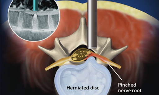 Endoscopic Discectomy