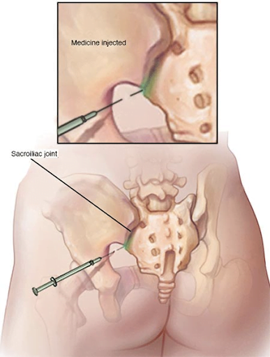 SI Joint Injections Procedure