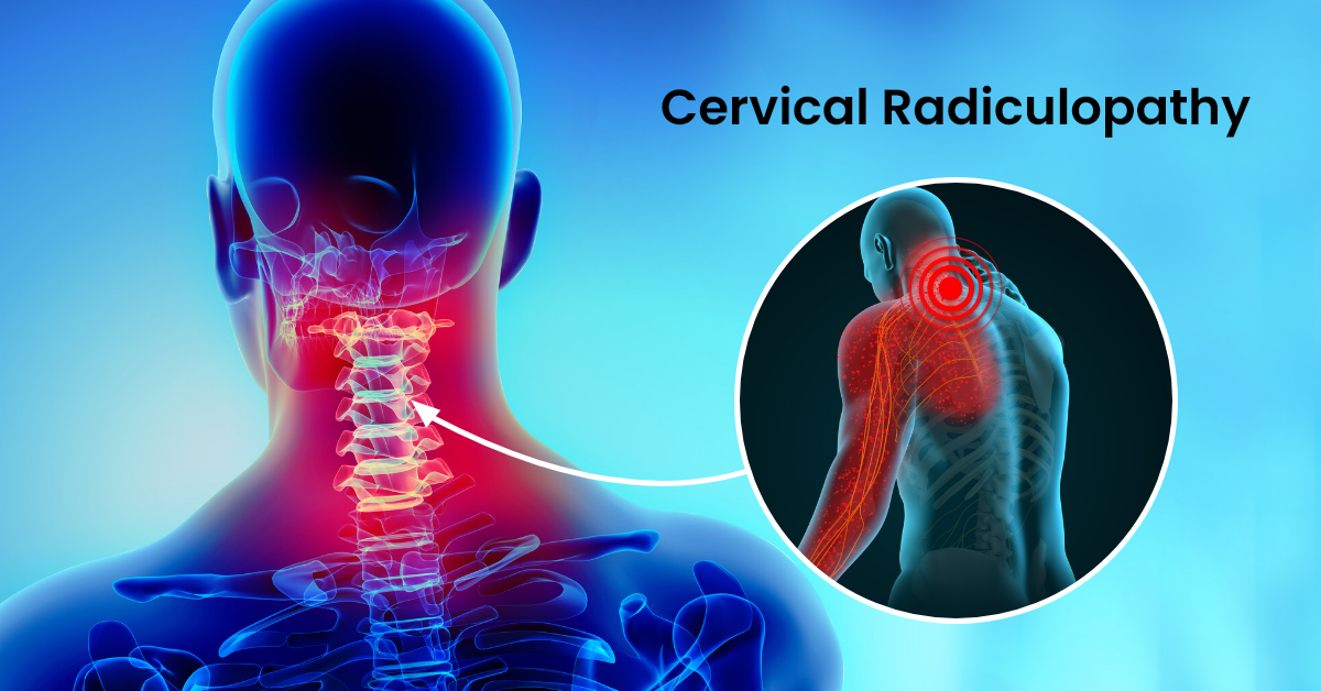 Cervical Radiculopathy