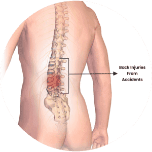 Back Injuries From Accidents