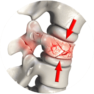 Compression Fractures Of The Spine