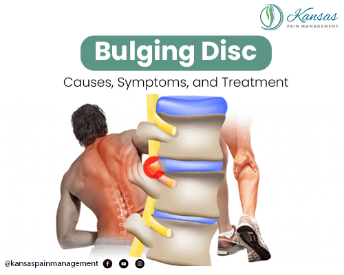 Causes of Bulging Discs