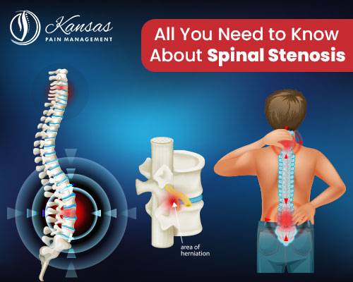 All You Need to Know About Spinal Stenosis