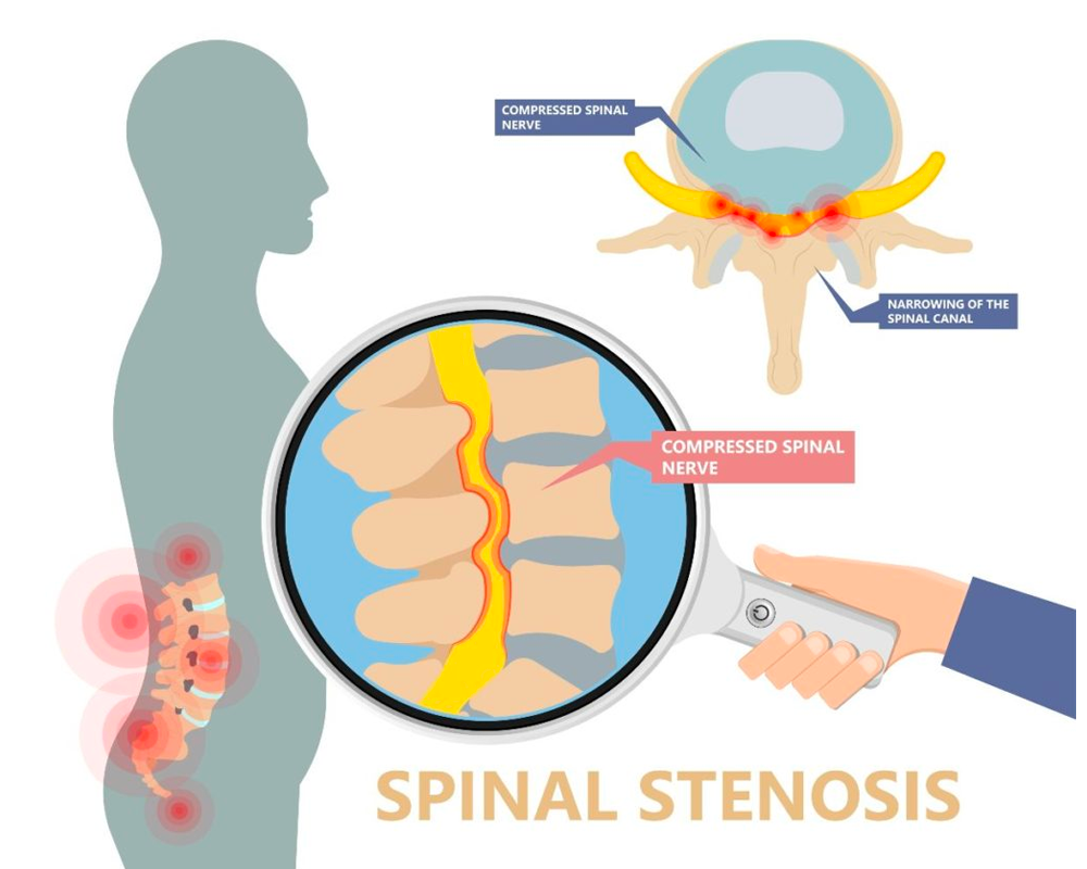 Lumbar Spinal Stenosis - Symptoms & Causes