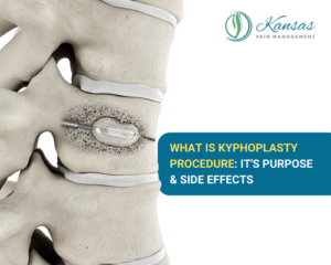 Kyphoplasty Procedure: It's Purpose & Side Effects