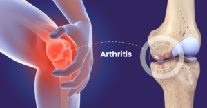 Know About Arthritis