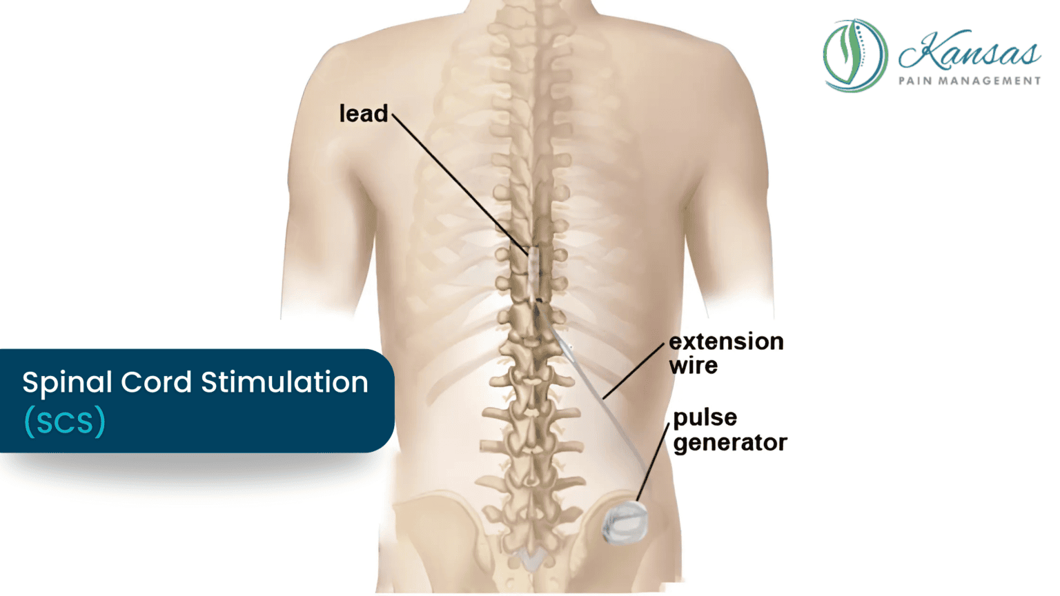 Spinal Cord Stimulation Doctors in Kansas City | Kansas Pain Management