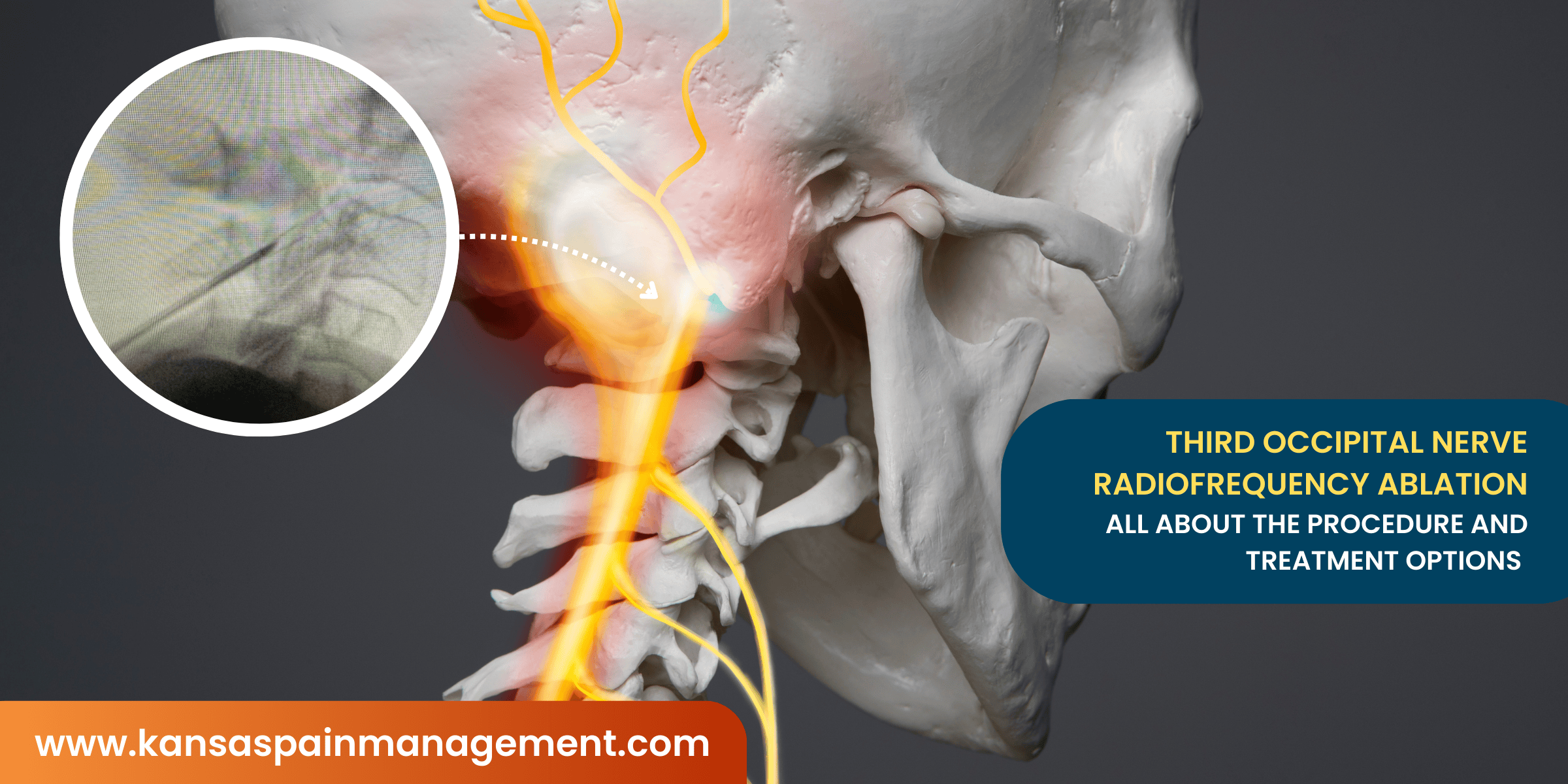 Third Occipital Nerve Radiofrequency Ablation (RFA)