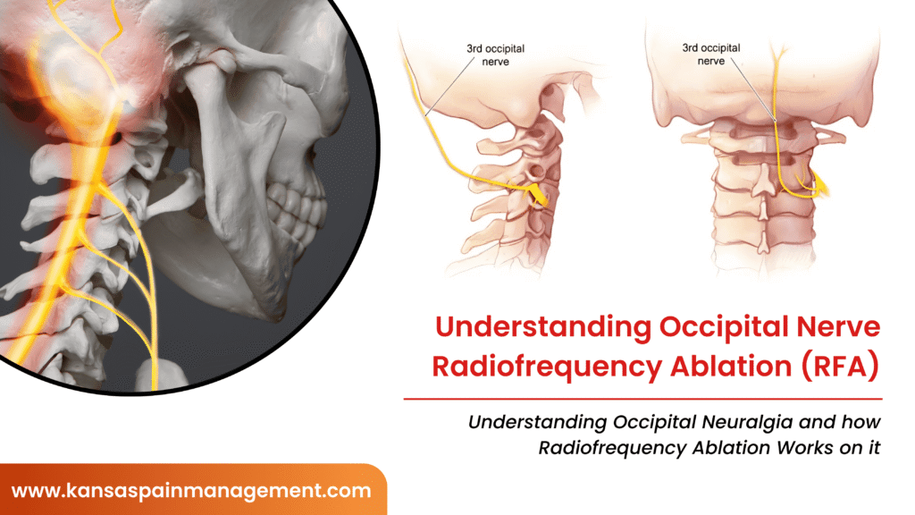 Occipital Nerve Radiofrequency Ablation (RFA)