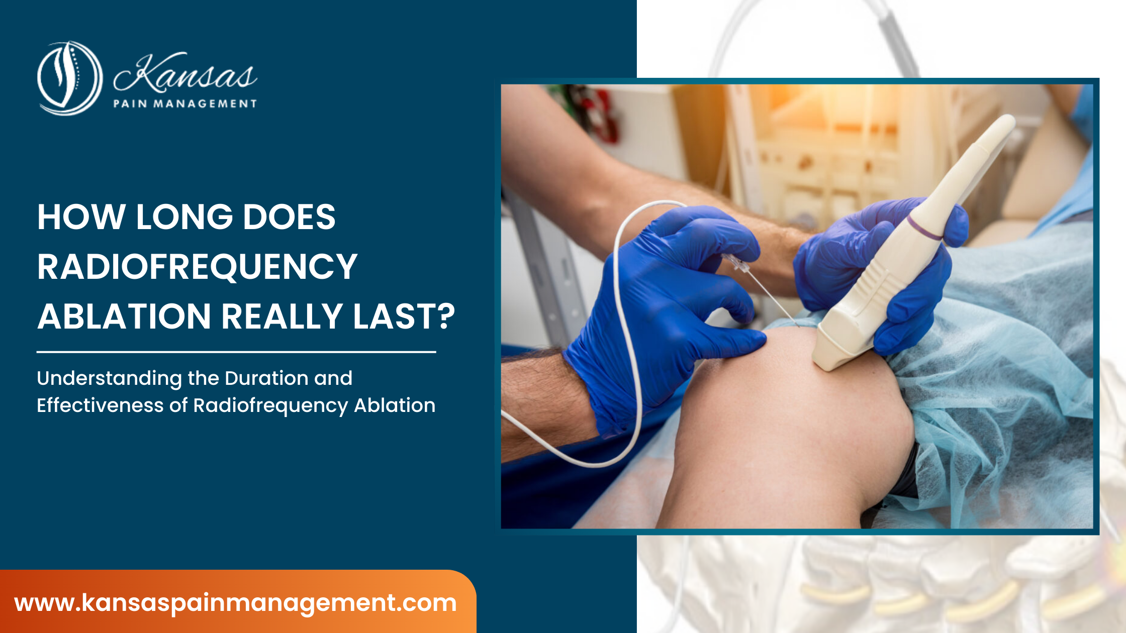 How-Long-Does-Radiofrequency-Ablation-Really-Last