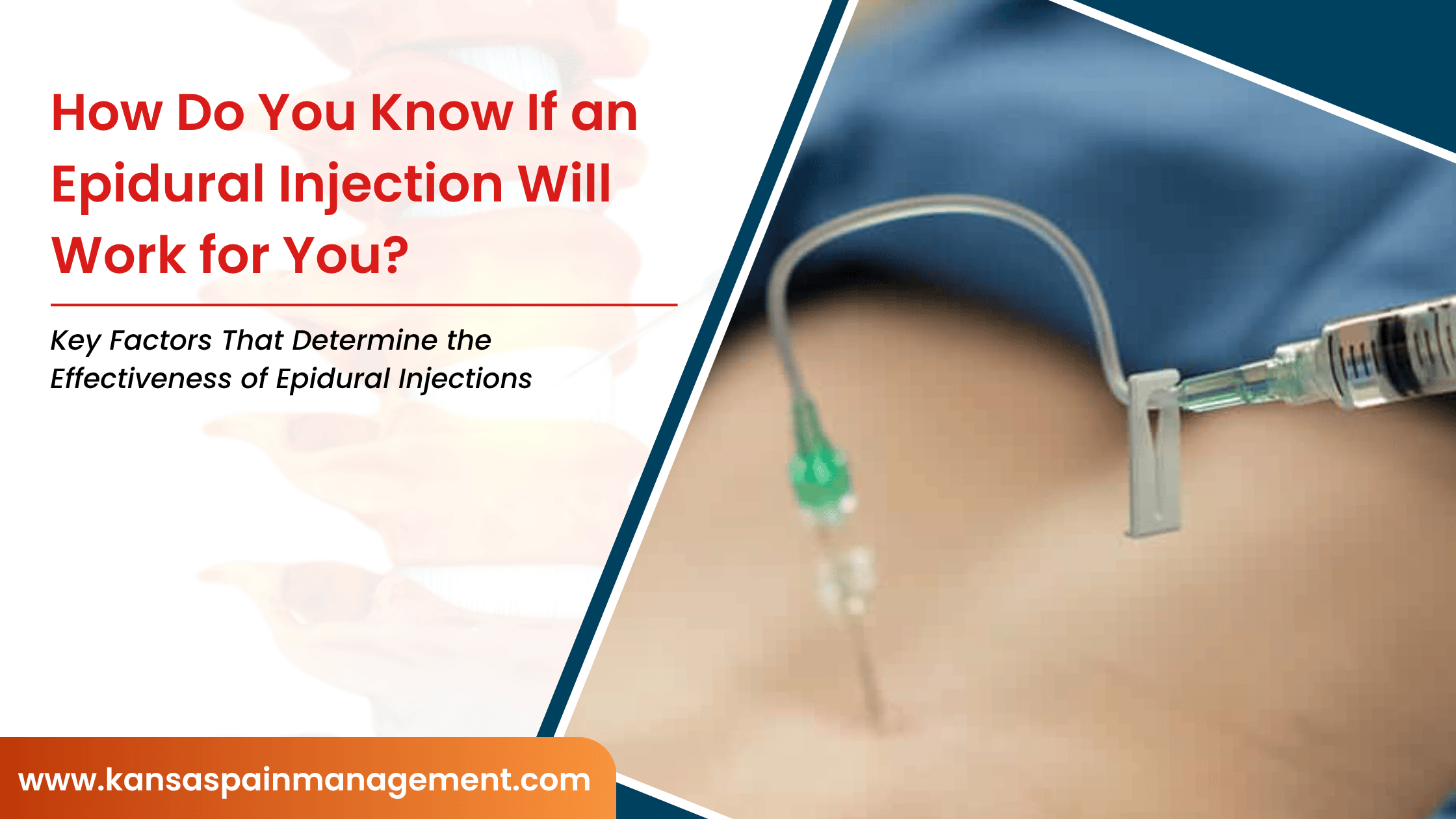 How-Do-You-Know-If-an-Epidural-Injection-Will-Work-for-You