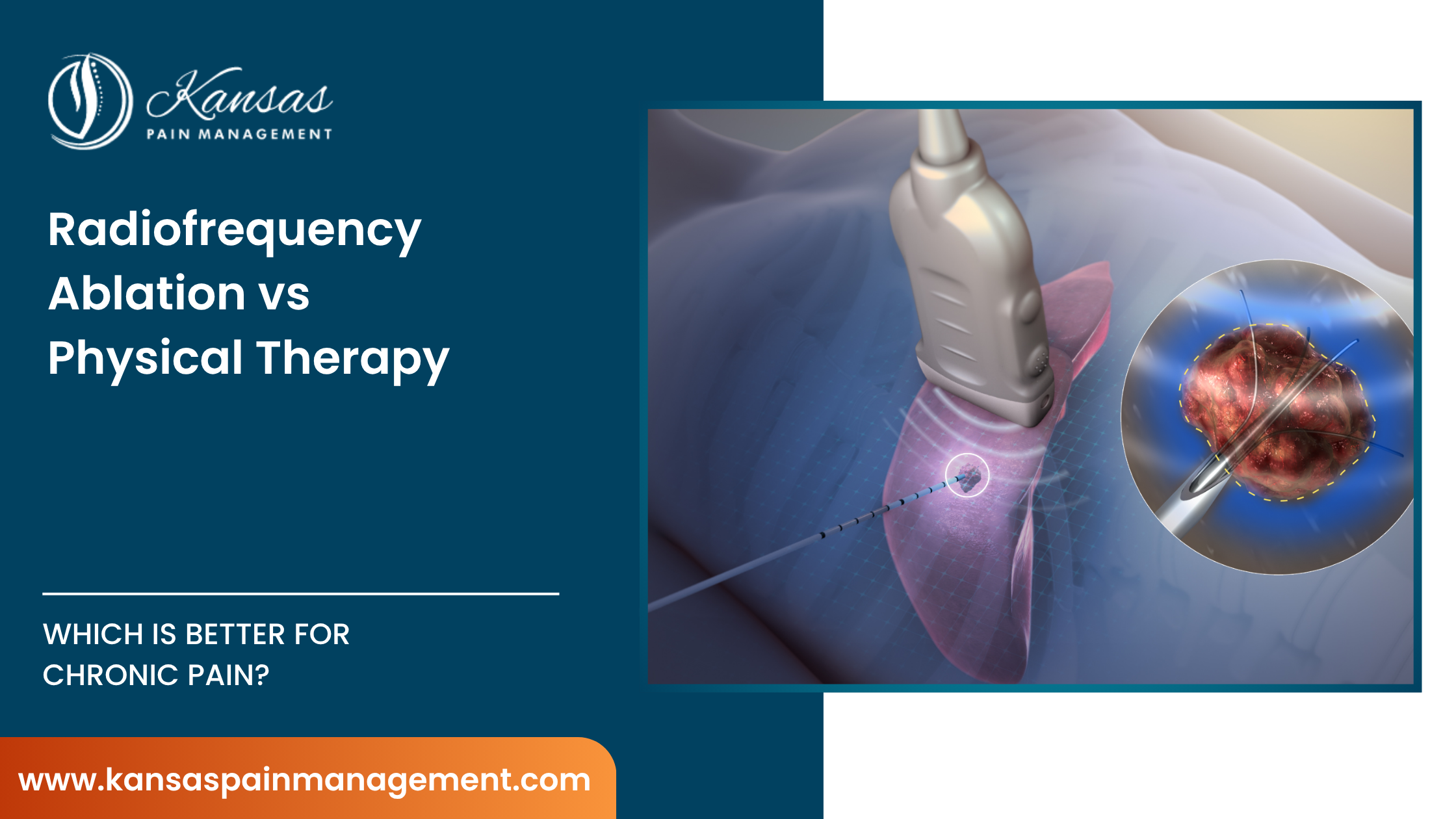 Radiofrequency-Ablation-vs-Physical-Therapy