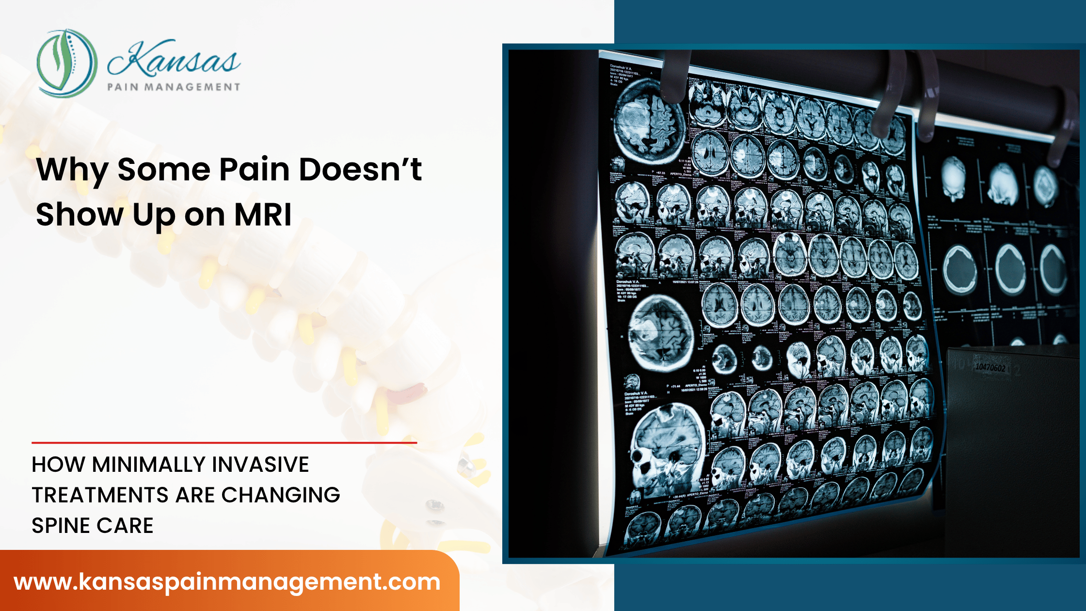 Why-Some-Pain-Doesnt-Show-Up-on-MRI