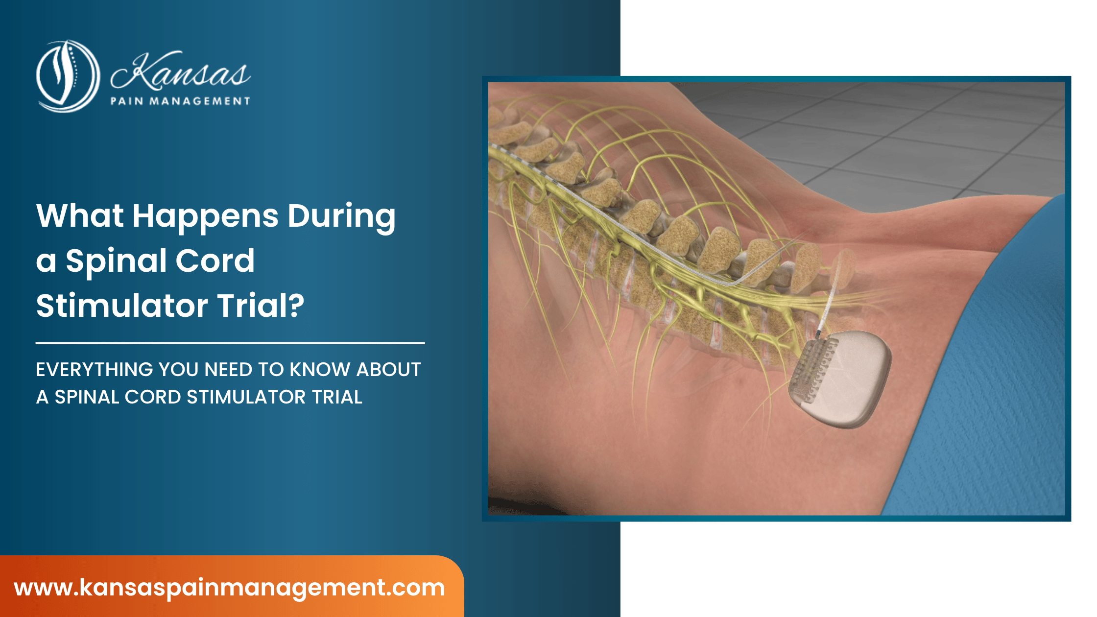 What-Happens-During-a-Spinal-Cord-Stimulator-Trial