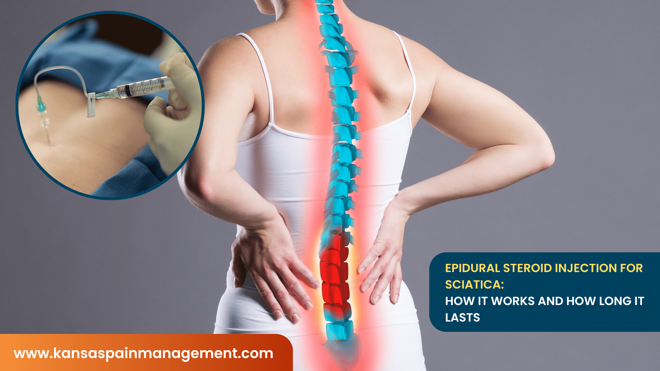 Epidural-Steroid-Injection-for-Sciatica-How-It-Works-and-How-Long-It-Lasts