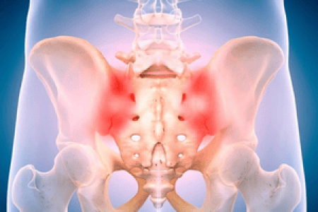 Sacroiliac Joint Pain-Grid